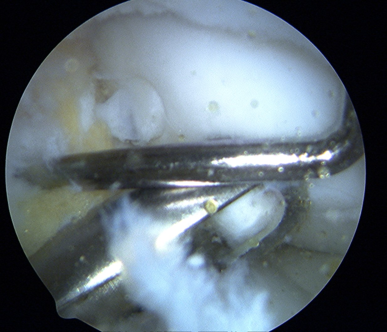 Mosaciplasty second plug